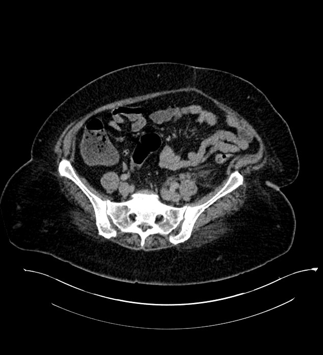 Chromophobe renal cell carcinoma (Radiopaedia 84239-99519 E 115).jpg