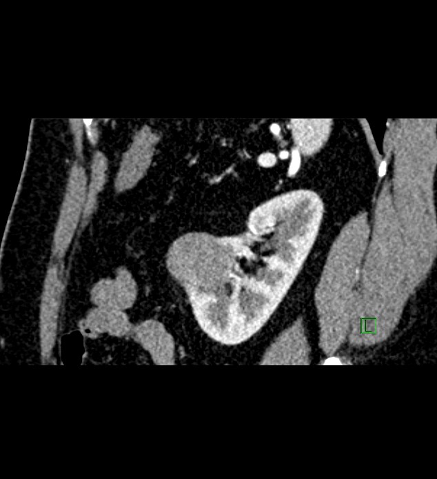 Chromophobe renal cell carcinoma (Radiopaedia 84286-99573 F 43).jpg