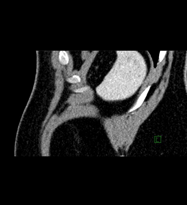 Chromophobe renal cell carcinoma (Radiopaedia 84286-99573 F 8).jpg