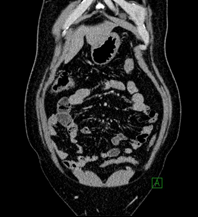 Chromophobe renal cell carcinoma (Radiopaedia 84286-99573 H 36).jpg