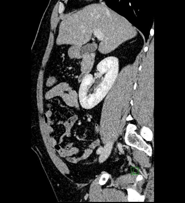 Chromophobe renal cell carcinoma (Radiopaedia 84286-99573 I 118).jpg