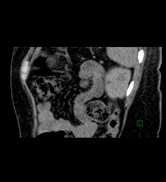 Chromophobe renal cell carcinoma (Radiopaedia 84290-99582 D 20).jpg