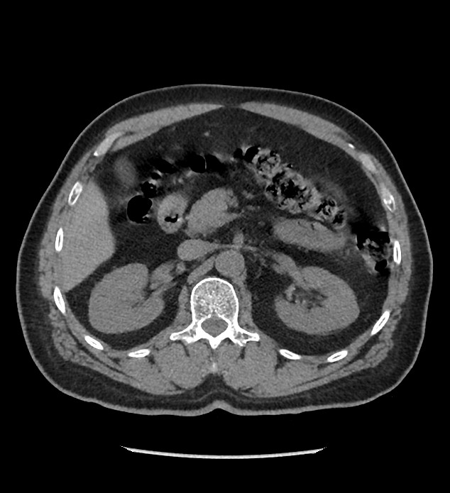 Chromophobe renal cell carcinoma (Radiopaedia 86879-103083 Axial non-contrast 31).jpg