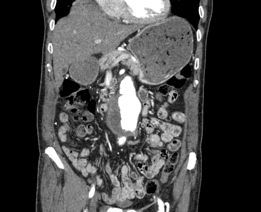 File:Chronic contained rupture of abdominal aortic aneurysm with extensive erosion of the vertebral bodies (Radiopaedia 55450-61901 D 18).jpg