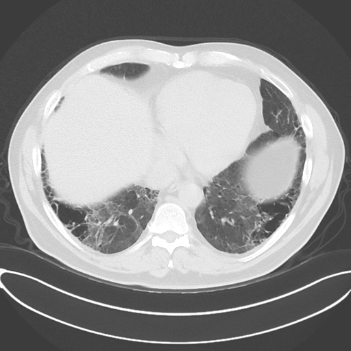 Chronic hypersensitivity pneumonitis (Radiopaedia 48107-52922 Axial lung window 44).png