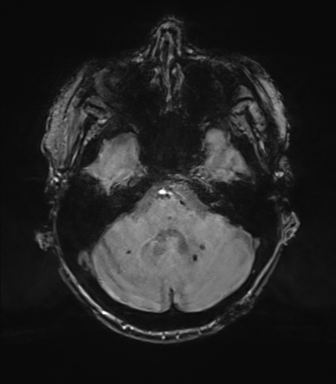 Chronic hypertensive encephalopathy (Radiopaedia 72844-83495 Axial SWI magnitude 20).png