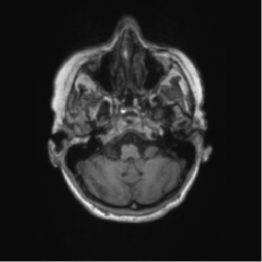 Chronic hypertensive encephalopathy (Radiopaedia 72844-83495 Axial T1 59).png