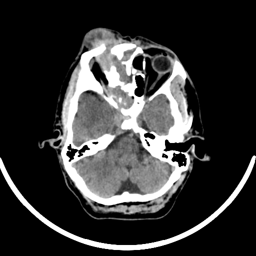 Chronic invasive fungal sinusitis with intraorbital and intracranial extension (Radiopaedia 56387-63046 Axial non-contrast 131).jpg
