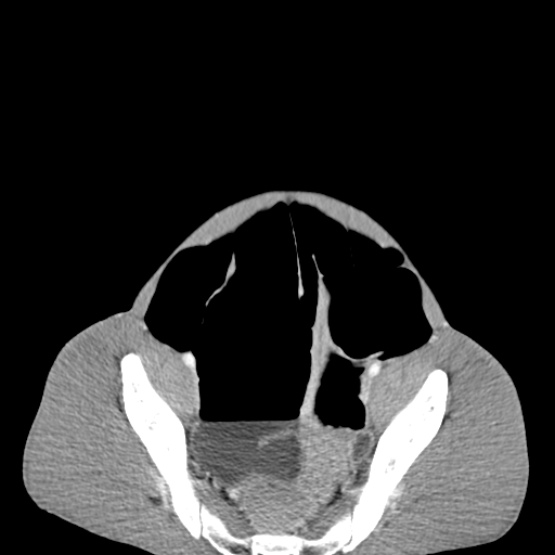 Chronic large bowel pseudo-obstruction (Radiopaedia 43181-46492 A 142).jpg