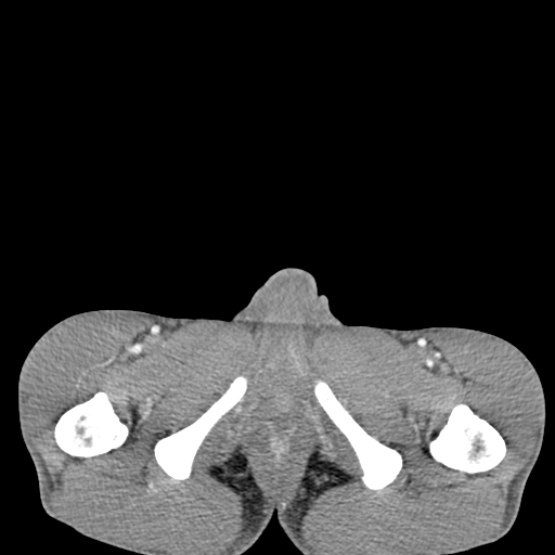 Chronic large bowel pseudo-obstruction (Radiopaedia 43181-46492 A 170).jpg