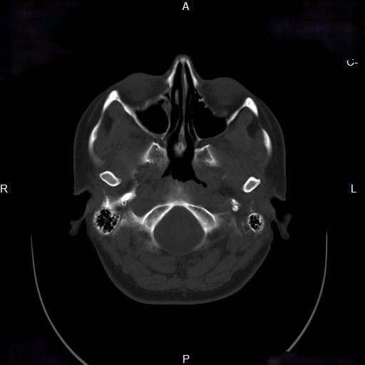 File:Chronic maxillary sinusitis with a foreign body (dental filling material) (Radiopaedia 7811-8639 Axial bone window 8).jpg