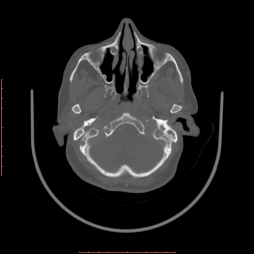 Chronic osteomyelitis - maxilla (Radiopaedia 23783-23927 Axial bone window 114).jpg