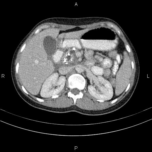 Chronic pancreatitis (Radiopaedia 64576-73450 C 47).jpg