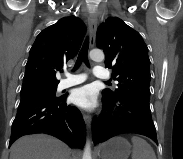 Chronic pulmonary embolus (Radiopaedia 39129-41341 Coronal C+ CTPA 48).png