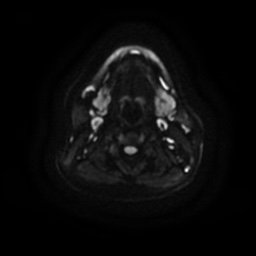 Chronic submandibular sialadenitis (Radiopaedia 61852-69885 Axial DWI 15).jpg