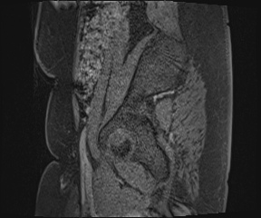 Class II Mullerian duct anomaly- unicornuate uterus with rudimentary horn and non-communicating cavity (Radiopaedia 39441-41755 G 120).jpg