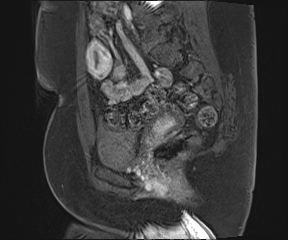 File:Class II Mullerian duct anomaly- unicornuate uterus with rudimentary horn and non-communicating cavity (Radiopaedia 39441-41755 G 43).jpg