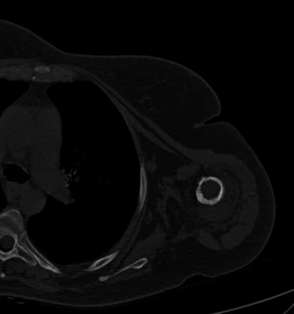 Clear cell chondrosarcoma - humerus (Radiopaedia 63104-71612 Axial bone window 68).jpg
