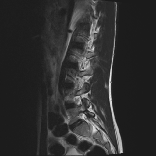 File:Clear cell meningoma - lumbar spine (Radiopaedia 60116-67690 Sagittal T2 13).png
