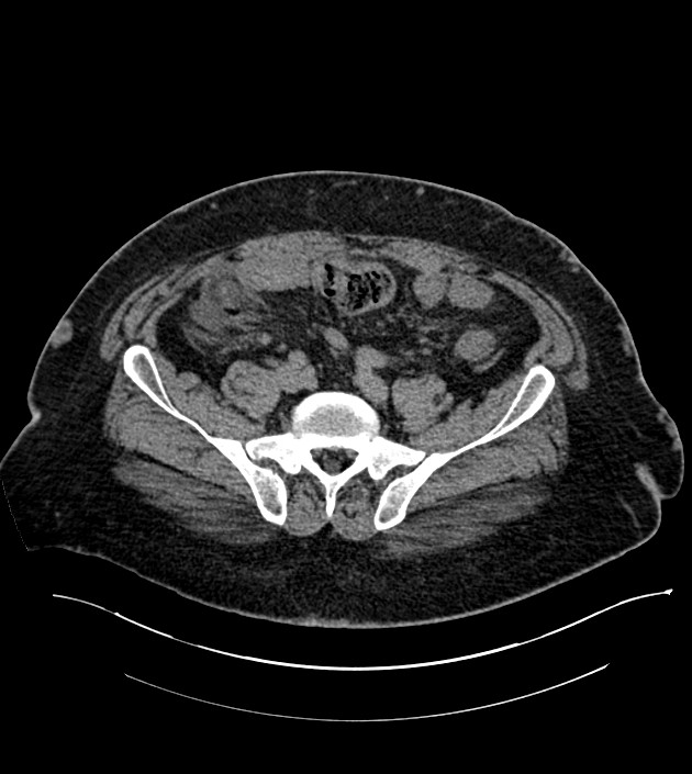 Closed-loop small bowel obstruction-internal hernia (Radiopaedia 78439-91096 Axial non-contrast 114).jpg