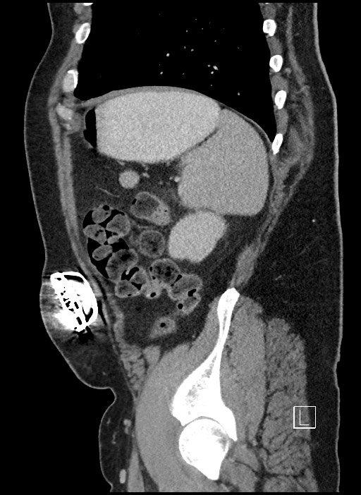 Closed loop obstruction - internal hernia into nephrectomy bed (Radiopaedia 59867-67320 C 11).jpg