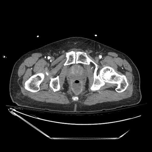 File:Closed loop obstruction due to adhesive band, resulting in small bowel ischemia and resection (Radiopaedia 83835-99023 B 154).jpg