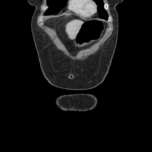 Closed loop small bowel obstruction (Radiopaedia 65403-74451 B 20).jpg