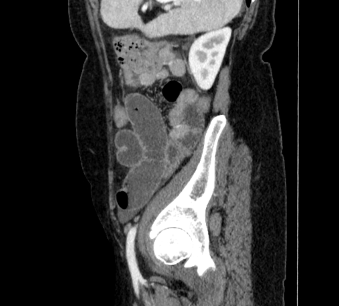 Closed loop small bowel obstruction (Radiopaedia 71211-81508 C 134).jpg