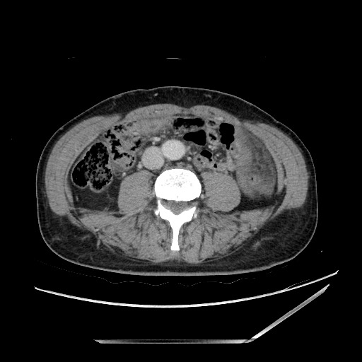 File:Closed loop small bowel obstruction - omental adhesion causing "internal hernia" (Radiopaedia 85129-100682 A 97).jpg