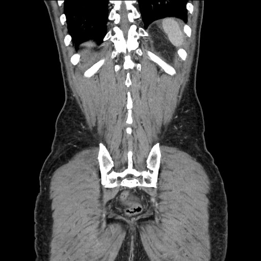 Closed loop small bowel obstruction - omental adhesion causing "internal hernia" (Radiopaedia 85129-100682 B 109).jpg