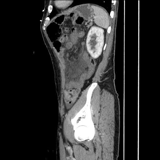Closed loop small bowel obstruction - omental adhesion causing "internal hernia" (Radiopaedia 85129-100682 C 139).jpg