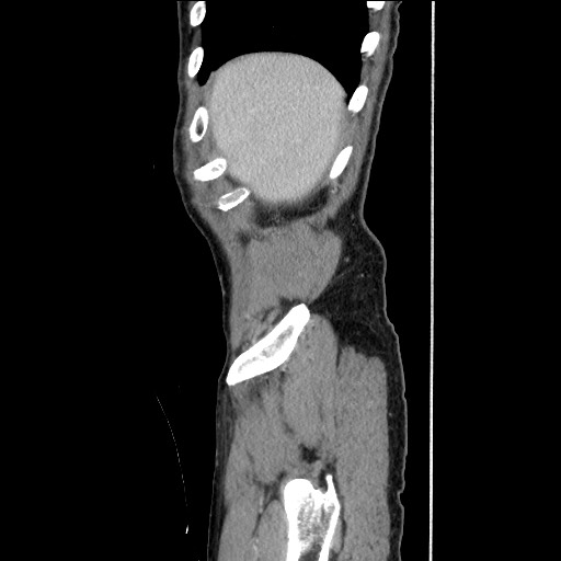 File:Closed loop small bowel obstruction - omental adhesion causing "internal hernia" (Radiopaedia 85129-100682 C 32).jpg