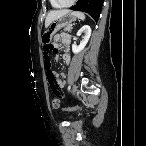 Closed loop small bowel obstruction due to adhesive bands - early and late images (Radiopaedia 83830-99014 C 117).jpg