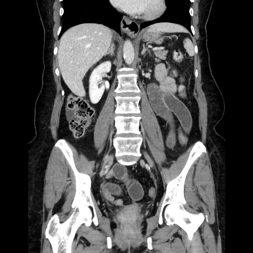 Closed loop small bowel obstruction due to adhesive bands - early and late images (Radiopaedia 83830-99015 B 73).jpg