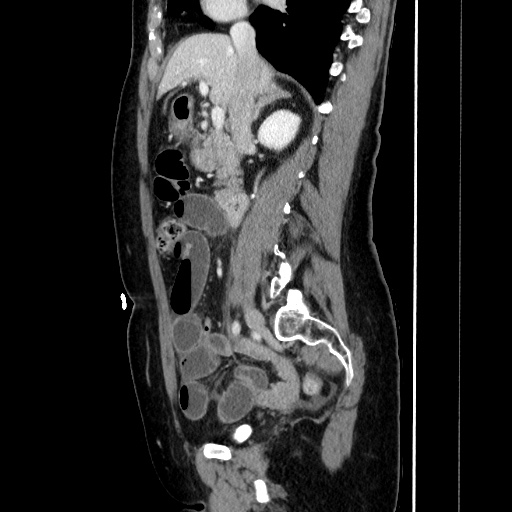 Closed loop small bowel obstruction due to adhesive bands - early and late images (Radiopaedia 83830-99015 C 77).jpg