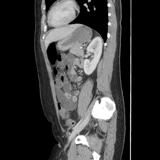Closed loop small bowel obstruction due to trans-omental herniation (Radiopaedia 35593-37109 C 44).jpg