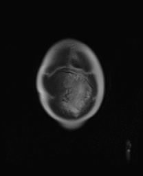 File:Closed loop small bowel obstruction in pregnancy (MRI) (Radiopaedia 87637-104031 Coronal T2 10).jpg