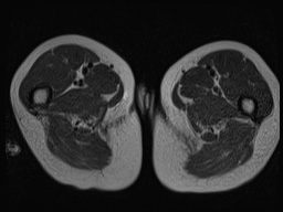 Closed loop small bowel obstruction in pregnancy (MRI) (Radiopaedia 87637-104031 D 53).jpg