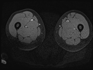 Closed loop small bowel obstruction in pregnancy (MRI) (Radiopaedia 87637-104031 G 70).jpg