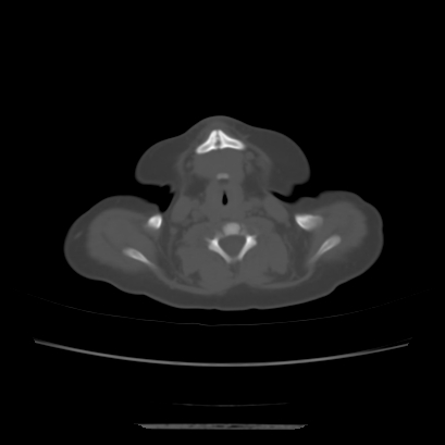 Cloverleaf skull (Radiopaedia 91901-109710 Axial bone window 15).jpg
