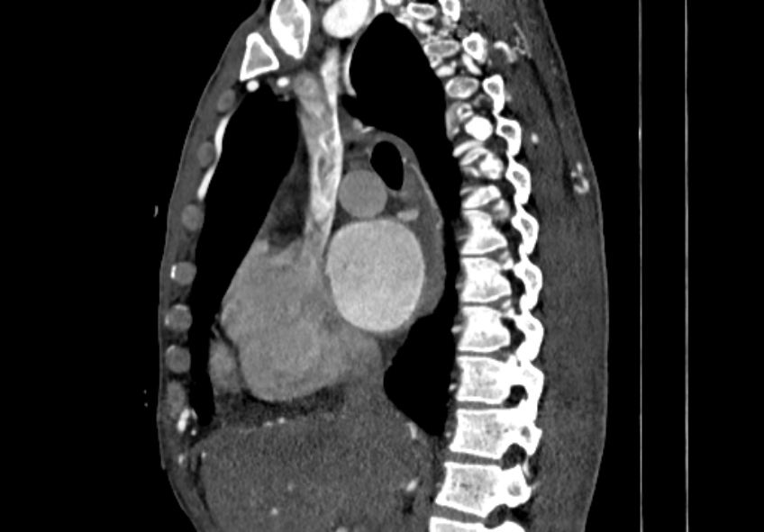 Coarctation of aorta with aortic valve stenosis (Radiopaedia 70463-80574 B 30).jpg