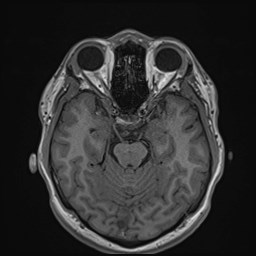 File:Cochlear incomplete partition type III associated with hypothalamic hamartoma (Radiopaedia 88756-105498 Axial T1 80).jpg
