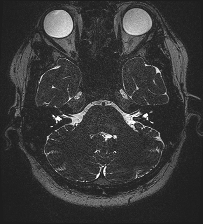 Cochlear incomplete partition type III associated with hypothalamic hamartoma (Radiopaedia 88756-105498 Axial T2 76).jpg
