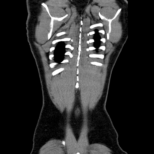 File:Codominant double aortic arch (Radiopaedia 56012-62637 B 45).jpg