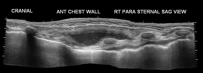 File:Cold abscess of chest wall (Radiopaedia 16037-15695 B 1).jpg