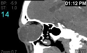 File:Colobomatous cyst (Radiopaedia 18034-17803 B 14).jpg