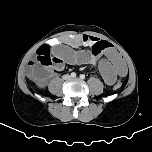 File:Colocolic intussusception due to large lipoma (Radiopaedia 68773-78482 A 119).jpg