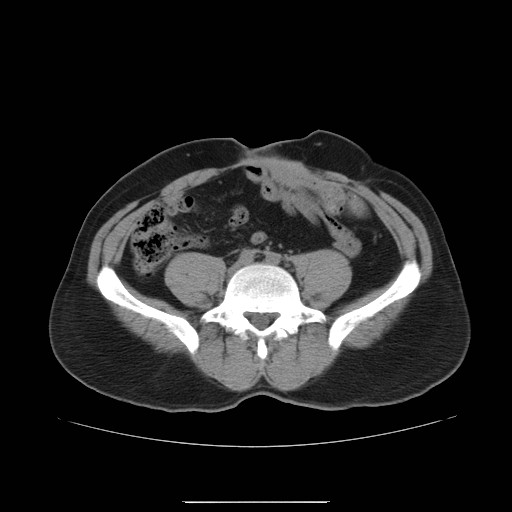 File:Colocutaneous fistula in Crohn's disease (Radiopaedia 29586-30093 Axial non-contrast 20).jpg