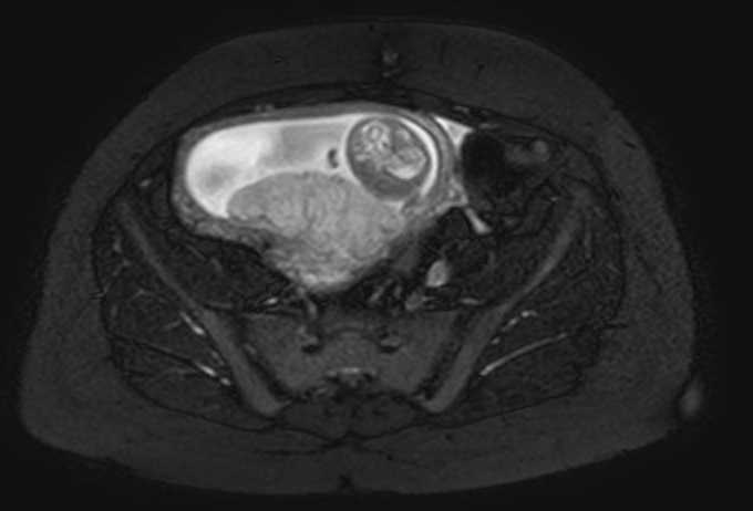 Colon adenocarcinoma with Krukenberg tumors, advanced pregnancy (Radiopaedia 67279-76645 Axial T2 SPAIR 22).jpg