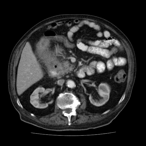 File:Colon cancer with duodenal invasion (Radiopaedia 16278-15958 A 24).jpg